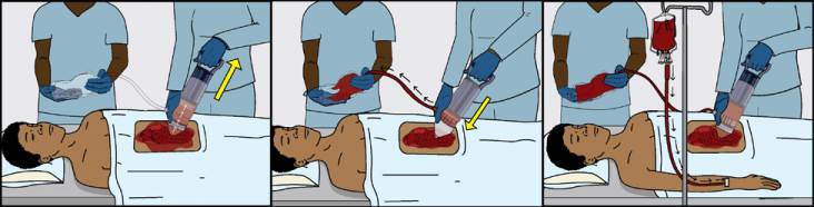 Graphic demonstrating Hemafuse in use